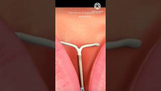 how to remove iud IUD shortsvideo views music [upl. by Kristie]