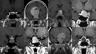 Tratamiento Quirúrgico de los ADENOMAS HIPOFISARIOS Dr Alvaro Campero [upl. by Ynnhoj]