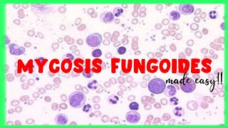 Mycosis Fungoides  WBC disorders  Sezary Syndrome [upl. by Pattani746]