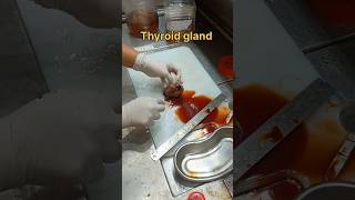 Cystic thyroid gland gross pathology [upl. by Ttevi]