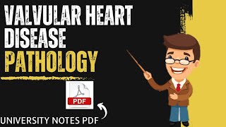 Valvular Heart Disease  CVS  Systemic Pathology  Pathology MBBS [upl. by Stevena]