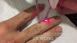 Laser to get rid of warts on Finger [upl. by Odlareg]