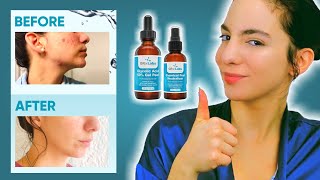 Eliminate Acne Scars with at home Glycolic Acid 50 Gel Peel [upl. by Nashom]