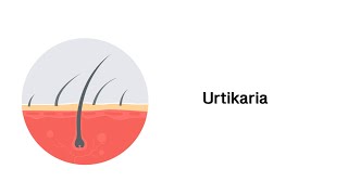 Nesselsucht Urtikaria  Erkrankungen der Haut [upl. by Elisabetta]