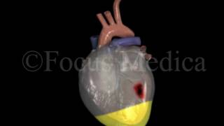 Pericardial effusion  Heart [upl. by Alina810]