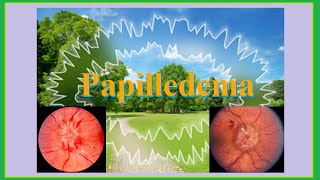 papilledema [upl. by Mitinger483]