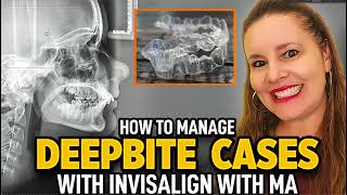 Invisalign with MA Deepbite Cases [upl. by Kciv]