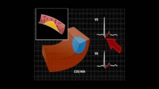 EKG zawał 2 [upl. by Ranip]