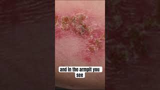 Bacterial Skin Infection Painful Sores [upl. by Midan95]