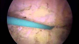 Arthroscopic Lateral Release and Medial Imbrication  ORV  Michael Magoline MD [upl. by Nnaeel]