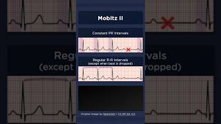 Type II Second Degree Atrioventricular Block ECG Regular RR intervals [upl. by Audley908]