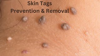 How To Remove and Prevent Skin Tags [upl. by Liakim]