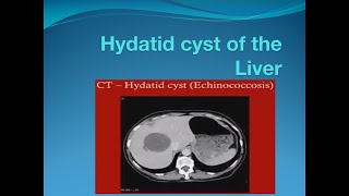 Hydatid cyst of the liver [upl. by Anitnauq85]