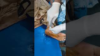 INTRAARTICULAR INJECTION FOR ANKLE PAIN [upl. by Treulich]