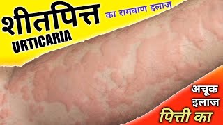 शीतपित्त पित्ती का अचूक इलाज   Urticaria Treatment  Dr Madhusudan [upl. by Zenobia166]