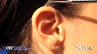 Allergy Auriculotherapy Ear Point [upl. by Emmons748]