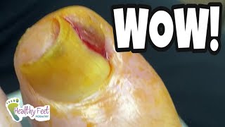 PATIENT THINKS HE CAN REMOVE HIS OWN INGROWN TOENAIL [upl. by Yttel]