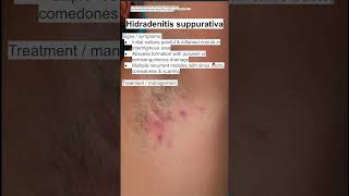 Hidradenitis suppurativa [upl. by Elehcor704]