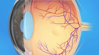 Central Retinal Vein Occlusion [upl. by Aven]