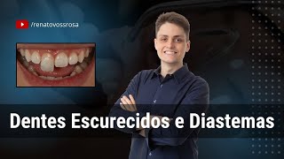 Dentes Escurecidos e Diastemas [upl. by Nimesay]