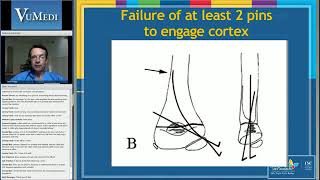 Supracondylar Fractures of the Humerus in Children VuMedi [upl. by Philly]