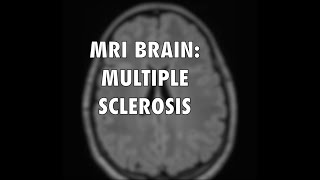 Multiple Sclerosis MRI [upl. by Della]