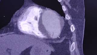 Myocardial Infarction sequelae  CT findings [upl. by Eivol]