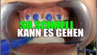 SO SCHNELL wird die FESTE ZAHNSPANGE eingesetzt  Orthodentix [upl. by Mika]