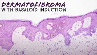 Dermatofibroma with basaloid follicular induction pathology mimic of basal cell carcinoma dermpath [upl. by Centeno]