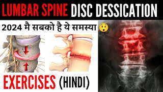 Disc desiccation with diffuse disc bulge  L4L5 L5S1 Low back pain पैरो मै दर्द  सुन्नपन जलन [upl. by Ahsakal]