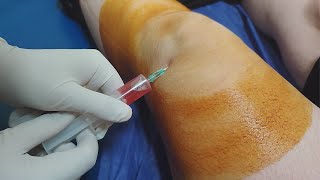 Knee fluid removal  Arthrocentesis  Synovial fluid aspiration procedure [upl. by Llenyar]