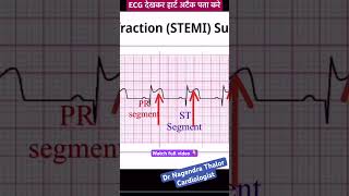 ECG से खुद हार्ट अटैक पता करे I How to read Heart attack ECG I ecg echo shorts [upl. by Cheslie]