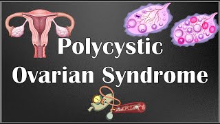 Polycystic Ovarian Syndrome PCOS  Causes Signs amp Symptoms Diagnosis amp Treatment [upl. by Annahvas]