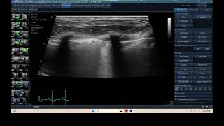 iq 306 tfast lung ultrasound echopac analysis PTE THROMBOEMBOLISM [upl. by Urias84]