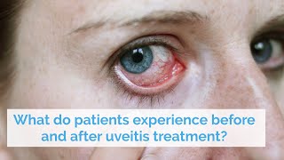 What do patients experience before and after uveitis treatment [upl. by Andrews]