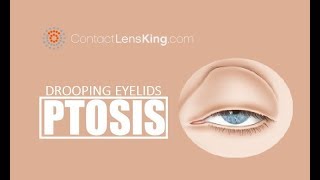 Drooping Eyelids  What causes Ptosis and How is it Treated [upl. by Leafar]