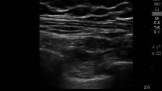 ultrasound guided intercostal nerve block 2 [upl. by Richmound]