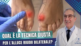 L ALLUCE RIGIDO BILATERALE compromette la postura  Quando operare lalluce rigido [upl. by Elicec884]