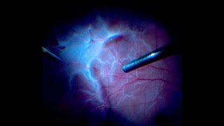 Vitrectomy for PVRInduced Retinal Detachment with Peripheral Retinotomy Ensuring Retinal Stability [upl. by Hiasi]