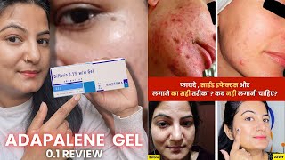 How to Use Adapalene Gel 01  Full Detail Video  Best Gel For Removing Blackheads and Pimples [upl. by Lenhart]