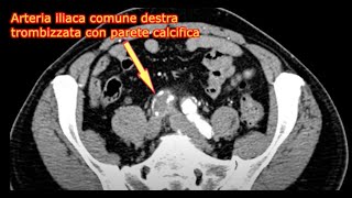 ARTERIOPATIE DEGENERATIVE ACQUISITE E FATTORI DI RISCHIO Serie Casi Clinici Multimediali n32023 [upl. by Getter]