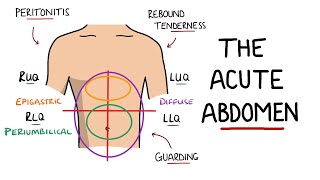 Acute Abdomen  A Guide to Acute Abdominal Pain [upl. by Legnaesoj]