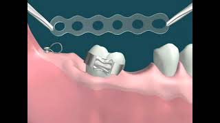 Dental Video of Molar Uprighting with Implants [upl. by Rezzani]