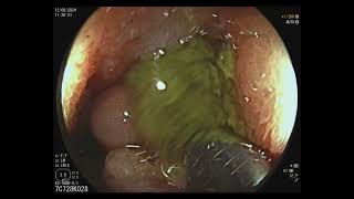 Subocclusion Treated by Colonic Stent Placement [upl. by Eceinwahs]