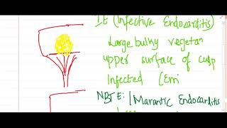 vegetations in endocarditis  Pathology [upl. by Dessma]