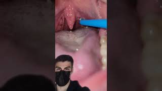 Using A WATER PIK To Remove Tonsil Stones [upl. by Susan474]