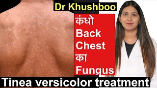 Tinea Versicolor Treatment  सेहुआ करोडियासीप Tinea body fungus treatment [upl. by Anialram]