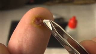 Results of Wart Treatment on Thumb Using Acid [upl. by Fasto]