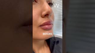 Before and after Restylane Kysse Lip Filler results with Dr Wise for a naturallooking plumped pout [upl. by Mike]