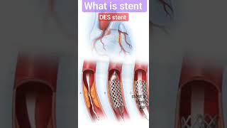 What is stent l How to it work l DES l stentछल्ला क्या होता है Shorts [upl. by Haropizt177]